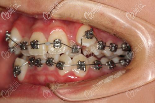 戴金属自锁托槽矫正牙齿拥挤
