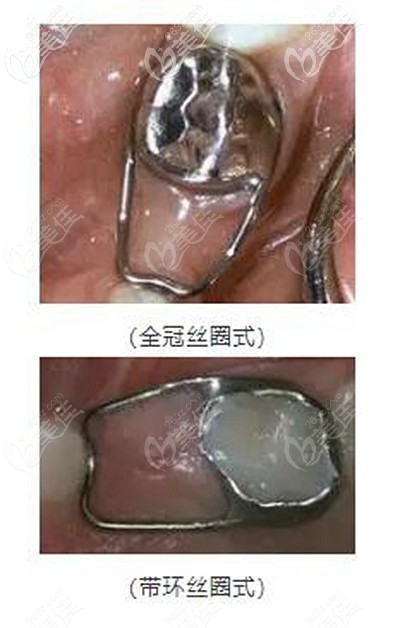 牙齿间隙保持器的不同类型 牙齿间隙保持器的不同类型