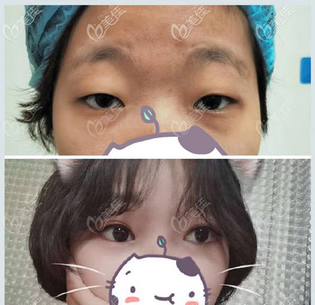 广东省<!--<i data=20240703-sp></i>-->赵成利医生双眼皮开眼角<span style=