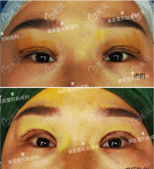 广州赵成利医生埋线双眼皮失败修复<span style=