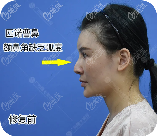 分享我第三次隆鼻成功亲身经历 分享我第三次隆鼻成功亲身经历