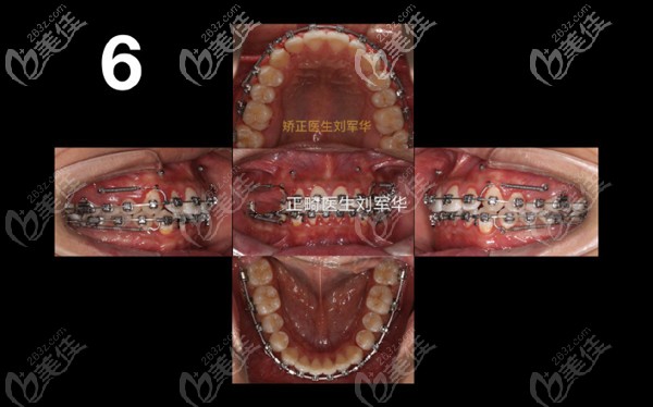 金属自锁托槽矫正<span style= 金属自锁托槽矫正<span style=