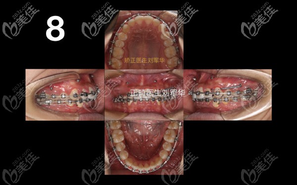 支抗钉前移上颌效果 支抗钉前移上颌效果