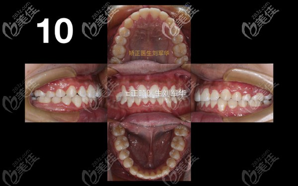 我戴了3年金属自锁托槽并种植支抗钉辅助远移上颌全牙列，解决了拥挤牙齿