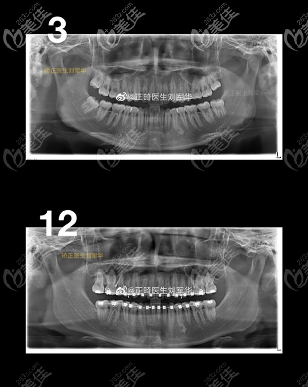 矫正后ct图对比 矫正后ct图对比