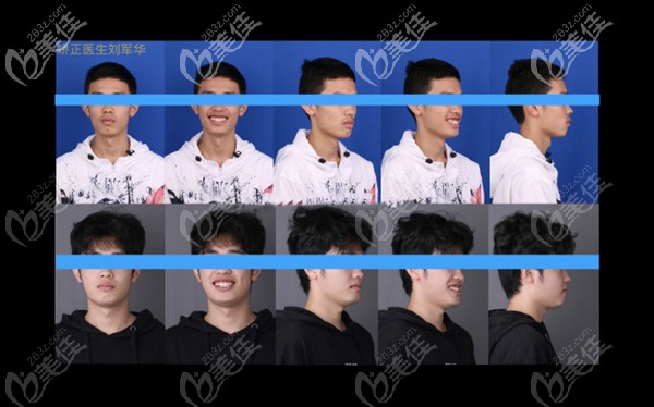 矫正前后效果对比 矫正前后效果对比