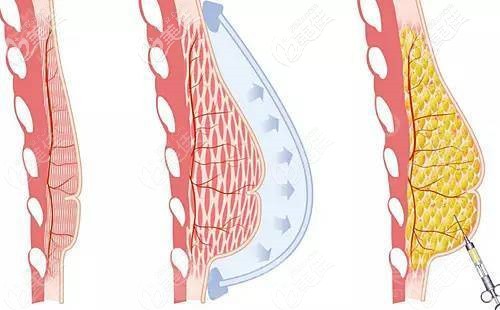 玻尿酸丰胸效果