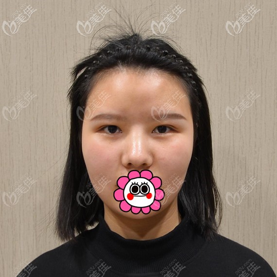 双眼皮不明显找俞国宝做修复 双眼皮不明显找俞国宝做修复