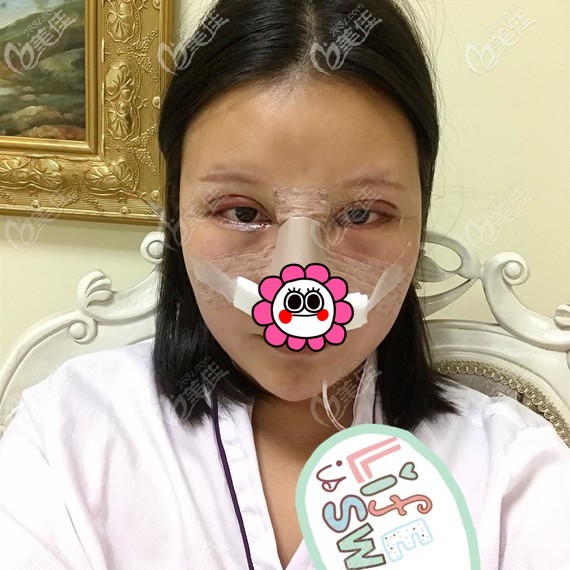 双眼皮修复术后即刻 双眼皮修复术后即刻