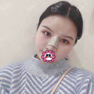 双眼皮修复术后12天 双眼皮修复术后12天