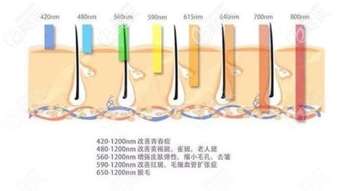 光子嫩肤的治疗原理