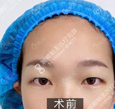 双眼皮术前 双眼皮术前