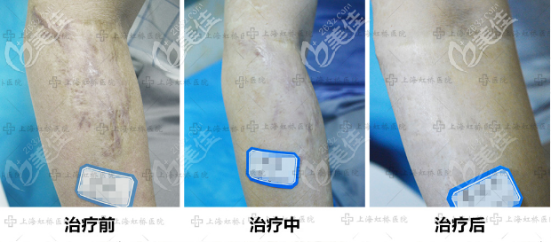 上海虹桥疤痕修复案例科普手术祛疤和激光祛疤区别