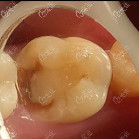 3m纳米树脂补牙 3m纳米树脂补牙