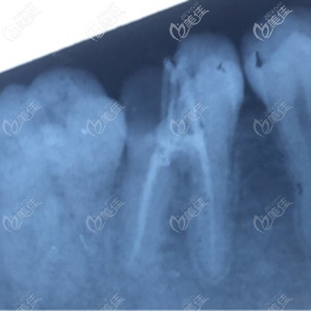 补牙前的牙齿状态 补牙前的牙齿状态