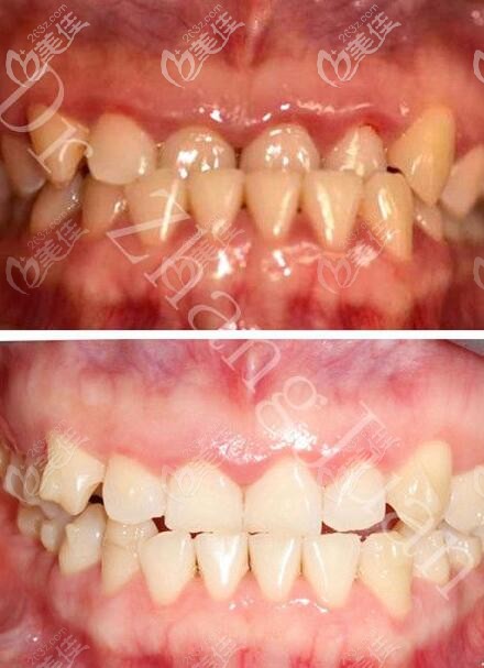 地包天隐适美隐形矫正三个月太赞,价格再贵都值,感谢深圳马泷齿科张娟医生
