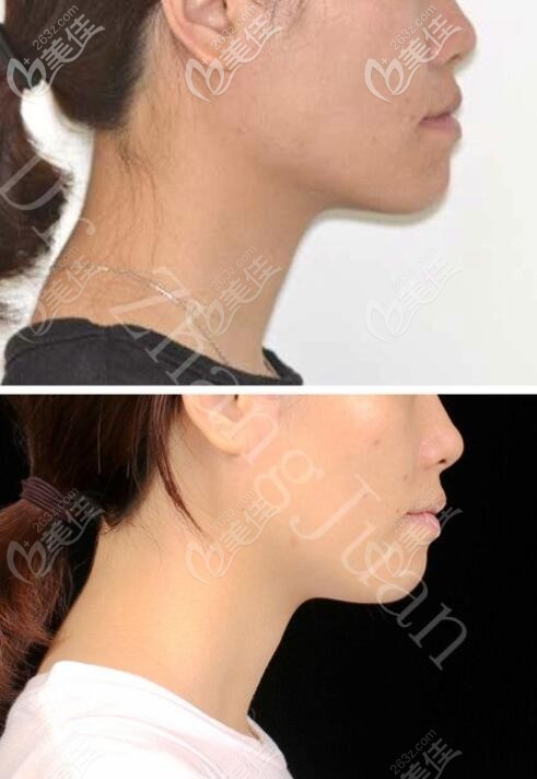 深圳马泷口腔张娟隐适美矫正案例