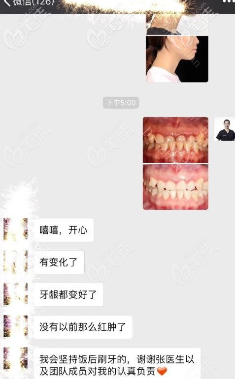 深圳马泷齿科正畸医生张娟矫正案例。