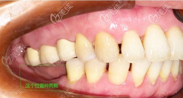 种牙前的口内照 种牙前的口内照