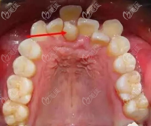 舔牙齿发现门牙分层图片
