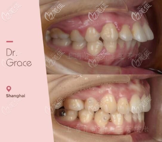 骨性龅牙+露龈笑矫正效果 骨性龅牙+露龈笑矫正效果