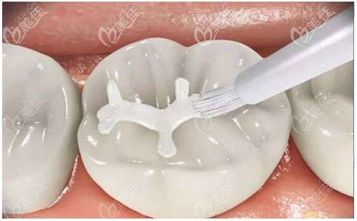 树脂补牙材料该如何选择？