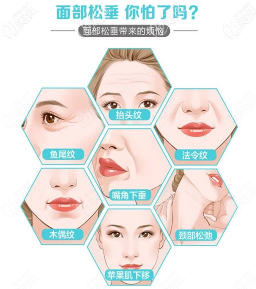 小切口面部提升适合的人群 小切口面部提升适合的人群