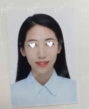 隐适美牙套矫正5个月效果图