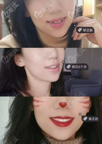 戴隐形牙套6-16个月变化图