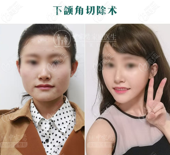 下颌角<span style=