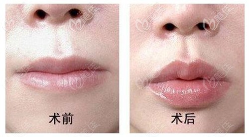 玻尿酸丰唇缩短人中效果对比 玻尿酸丰唇缩短人中效果对比