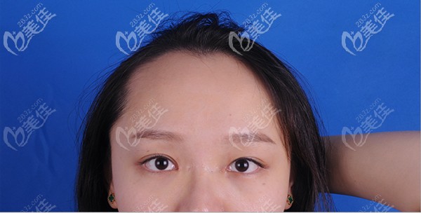 小姐姐发际线种植术前发际线很高 小姐姐发际线种植术前发际线很高