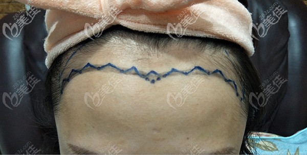 跟医生协商后设计的发际线形状 跟医生协商后设计的发际线形状