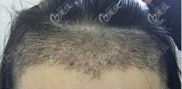 女生发际线越来越高怎么办？她选择在广州天姿种发际线让额头缩窄3厘米