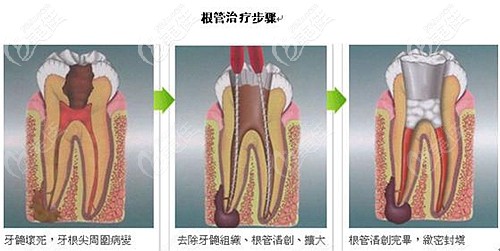 根管治疗的方式和过程