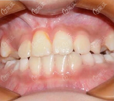洛阳八岁儿童门牙牵引手术案例，历时18个月牙齿正畸成功