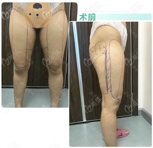 做腿部吸脂术大约多少钱?我做大腿抽脂肪花了14800多元 做腿部吸脂术大约多少钱?我做大腿抽脂肪花了14800多元