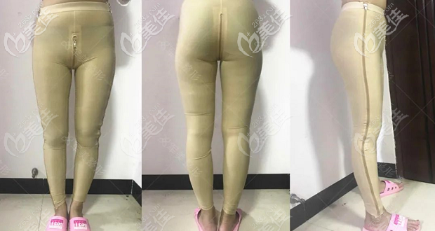 我做大腿抽脂肪花了14800多元 我做大腿抽脂肪花了14800多元