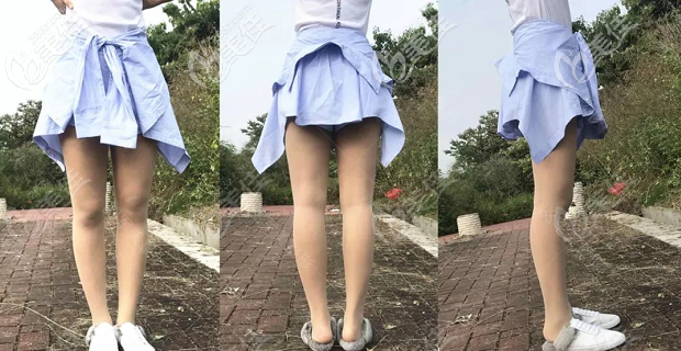 做腿部吸脂手术2个月效果 做腿部吸脂手术2个月效果