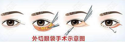 外切眼袋手术过程示意图
