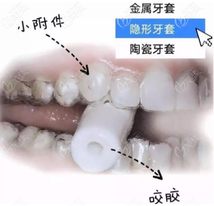 隐形牙套咬胶使用图示