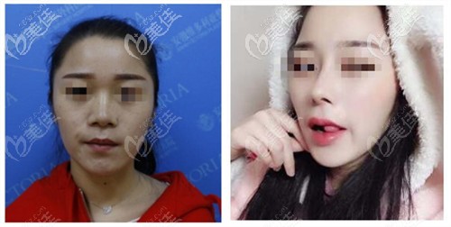 合肥维多利亚卫爱侠隆鼻案例 合肥维多利亚卫爱侠隆鼻案例