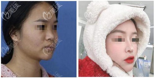 甘泉涌鼻综合案例 甘泉涌鼻综合案例