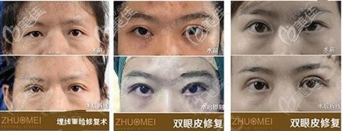 王海平院长双眼皮修复手术对比图
