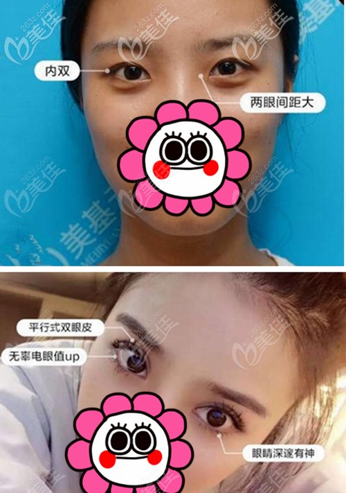 项利姣院长内双做双眼皮对比图