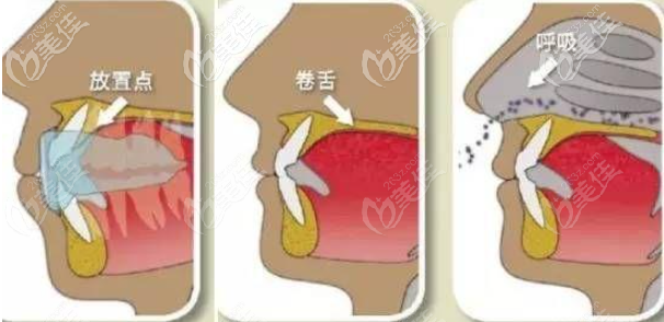 MRC牙齿矫正示意图