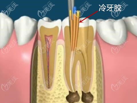 冷牙胶根管治疗填充示意图