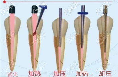 热牙胶根管治疗填充示意图