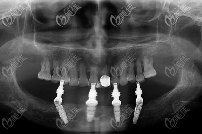 下半口用allon4种植的CT照片 下半口用allon4种植的CT照片