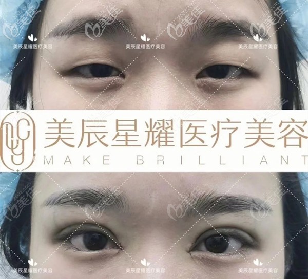 成都美辰星耀医疗美容院长江涛双眼皮案例 成都美辰星耀医疗美容院长江涛双眼皮案例